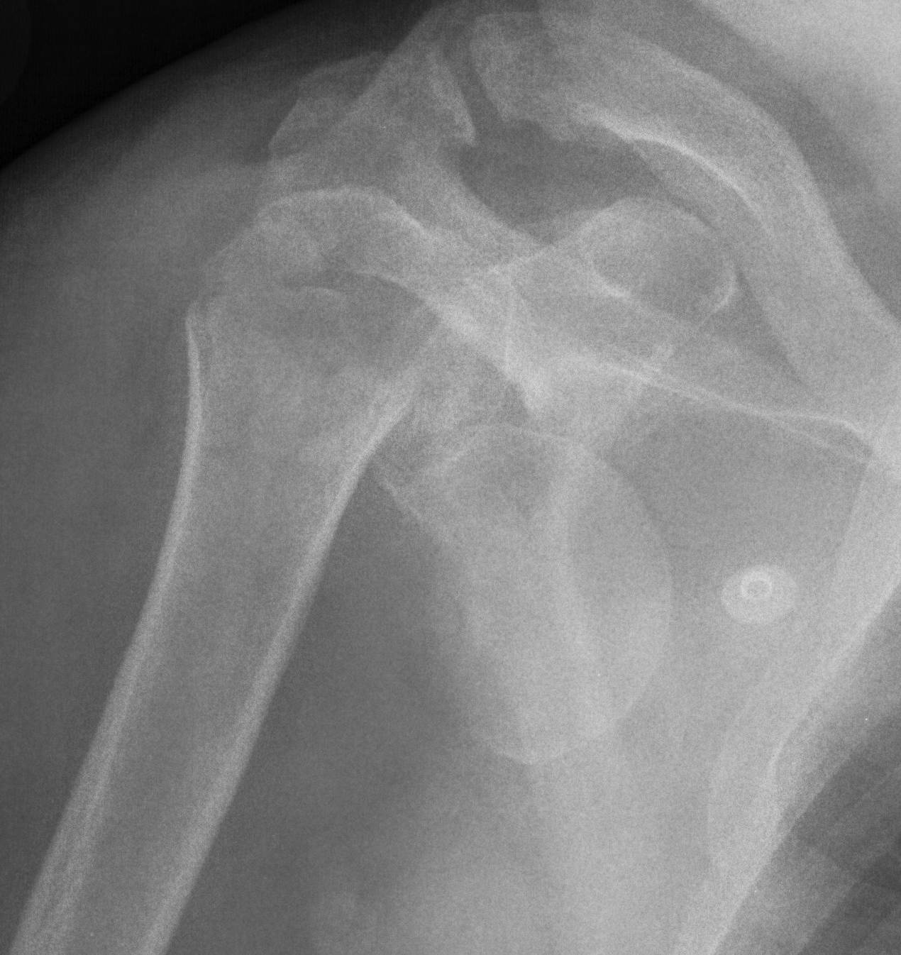 Proximal Humerus Fracture Dislocation